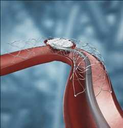 Stents intracraneales