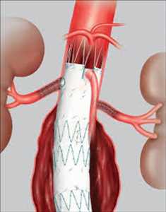 Global-Aortic-Repair-Devices-Market