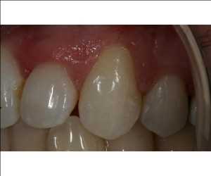 Global-Composite-Resins-Market