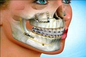 Global-Craniomaxillofacial-Fixation-CMF-Devices-Market