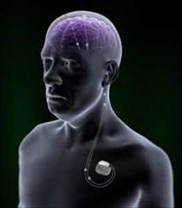 Global Dispositivos de estimulación cerebral profunda Tendencia del mercado