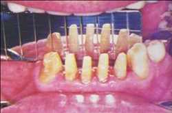 Global-Dental-Parallelometers-Market