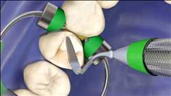 Global-Dental-Restoration-Dental-Consumables-Market