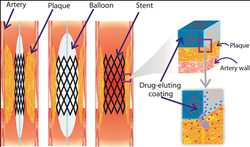 Global-Drug-Eluting-Stent-Market