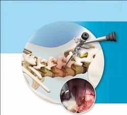 Global-Endoscopic-Spinal-Surgery-Market