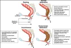 Global-Fecal-Incontinence-Market