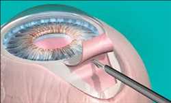 Global-Glaucoma-Surgery-Devices-Market