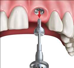 Global-Implant-Abutment-Market