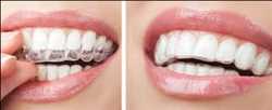 Global-Invisible-Orthodontics-Market