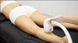 Global-Laser-Hair-Removal-Market