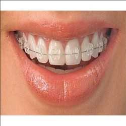 Global-Orthodontics-Dental-Consumables-Market