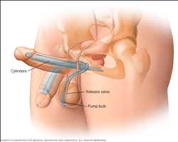 Global-Penile-Prostheses-Market