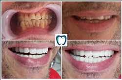 Global-Porcelain-Teeth-Market