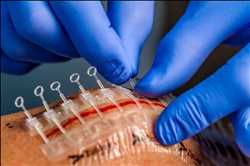 Global-Surgical-Incision-Closure-Devices-Market