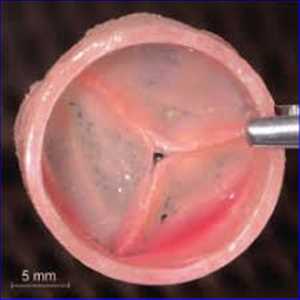 Global-Tissue-Engineered-Heart-Valve-Market