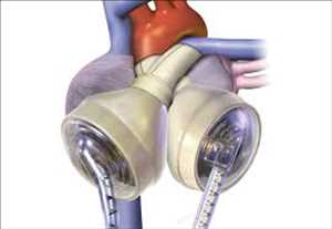 Global-Total-Artificial-Heart-Market