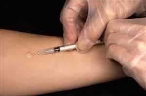 Global-Tuberculosis-Diagnostics-Market