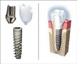Perspectiva global del mercado de bioimplantes