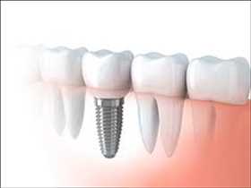 Visión global del mercado de implantes dentales