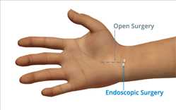 Perspectiva global del mercado Sistemas de liberación del túnel carpiano