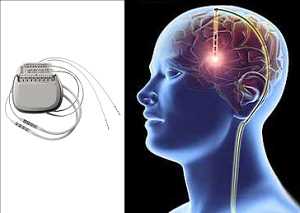 Perspectiva global del mercado de dispositivos de estimulación cerebral profunda