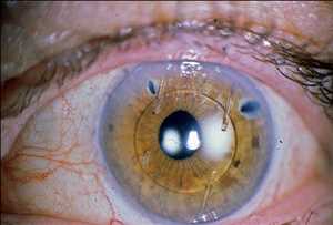 Tendencias del mercado mundial de lentes intraoculares (IOL)