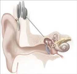 Pronóstico del mercado mundial de implantes cocleares unilaterales