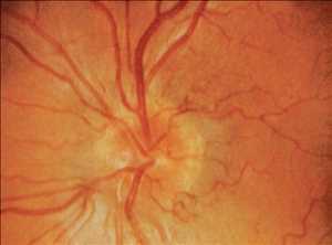  Información general sobre el mercado de fármacos para la neuropatía óptica hereditaria de Leber