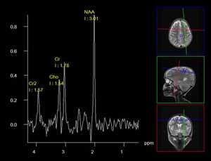  Oportunidades de mercado global de espectroscopia de resonancia magnética (MRS)