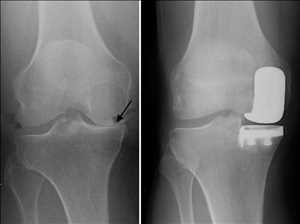  Jugadores lideres en el mercado mundial Reemplazo parcial de rodilla (PKR)