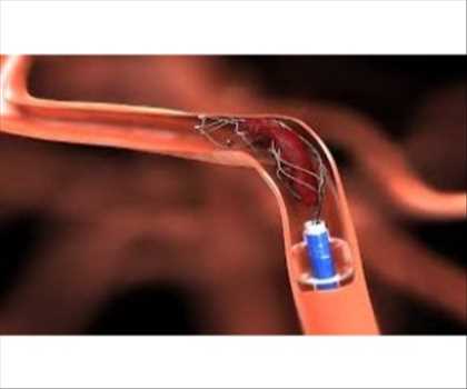 Stents neurovasculares Mercado