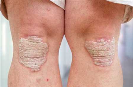 Artritis psoriásica Mercado