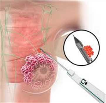 Biopsia de mama Mercado