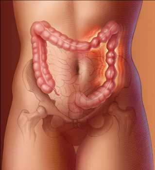 Diagnóstico del síndrome del intestino irritable (SII) Mercado