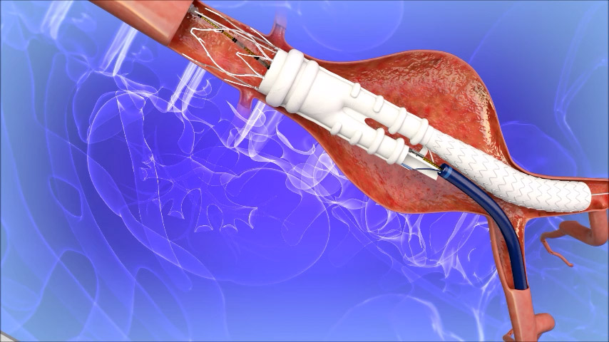 Sistema de injerto de stent abdominal Mercado