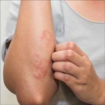 Tratamiento del eczema atópico Mercado
