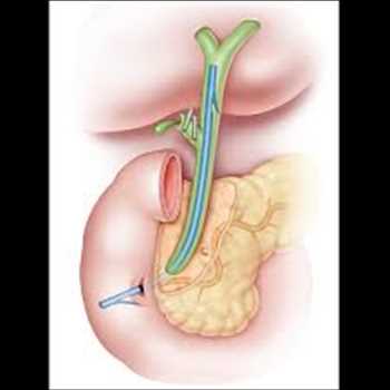 Stents biliares Mercado